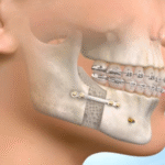 Understanding Jaw Surgery: What You Need to Know