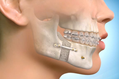 Understanding Jaw Surgery: What You Need to Know